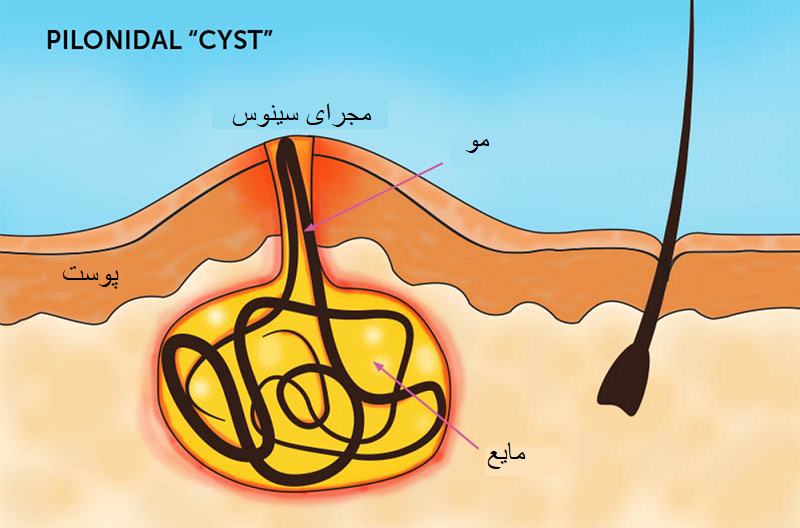موی برگشتی کجا درمیاد